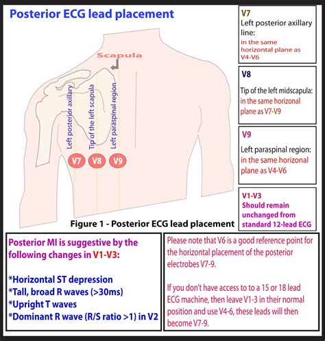 ECG Educator Blog : Posterior ECG Lead Placement