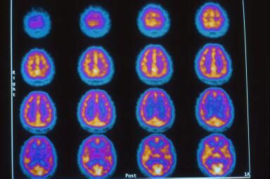 Image result for SPECT Scan Brain Prefrontal Cortex