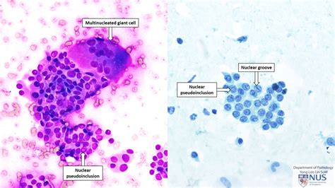 Thyroid | Cytoweb – Practical Cytopathology