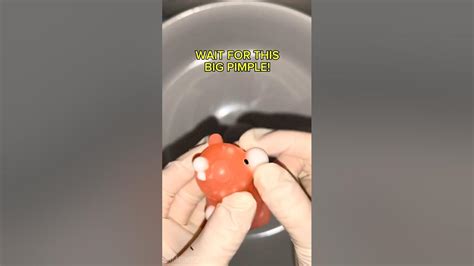 Image result for Large Pimples Exploding