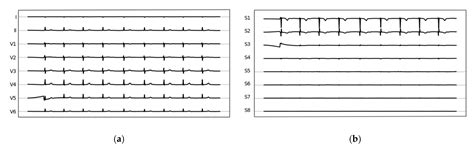 Diabetes without Overt Cardiac Disease Is Associated with Markers of ...