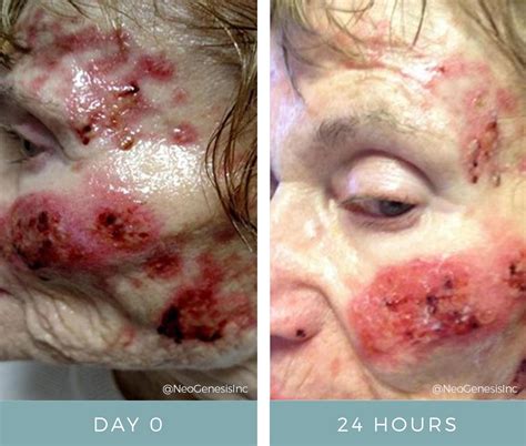Topical Chemotherapy Side Effects Before + After Photos