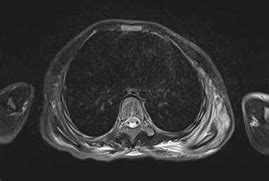 Fibrodysplasia ossificans progressiva - recognising the early features ...