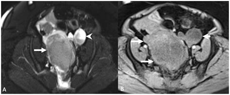 Suspensory Ligament Of Ovary Cat