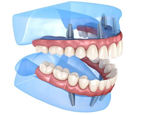Full Mouth Restoration with Dental Implantation in Turkey