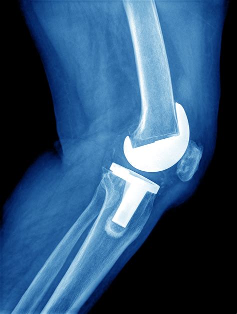 Knee Replacement Xray