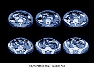 Ct Scan Abdomen Stock Photo (Edit Now) 666835783