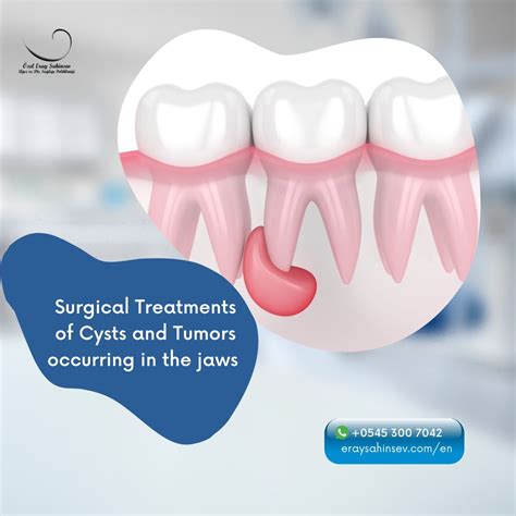 🎯Surgical treatments for cysts and tumors that occur in the jaws typically involve the removal ...