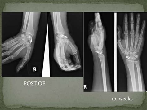 Scaphoid Fracture Test 的图像结果