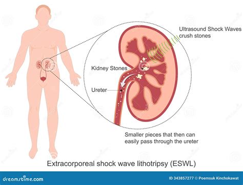 Lithotripsy Procedure 的图像结果