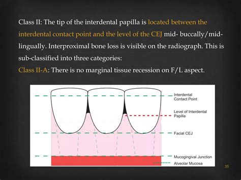 Gingival recession classifications | PPTX