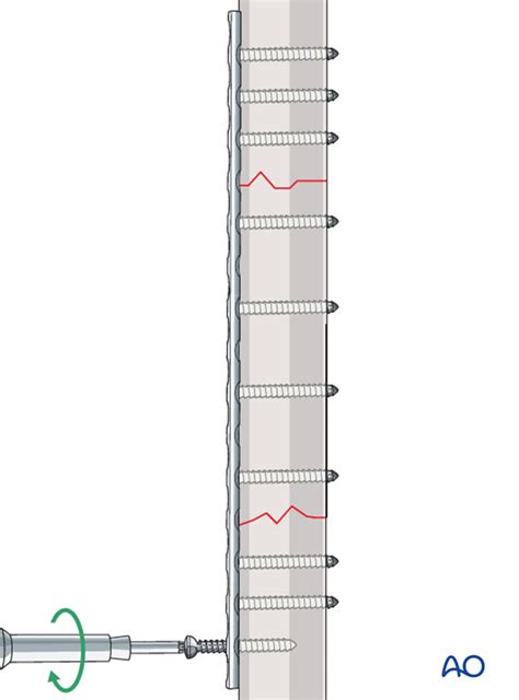 Compression Plate Ao 的图像结果