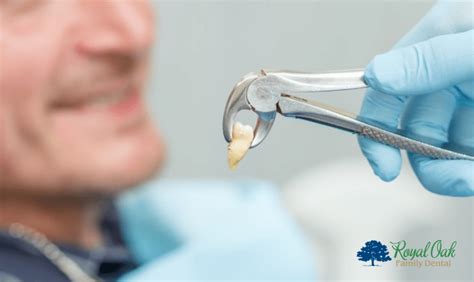 Image result for Basic Tooth Extraction