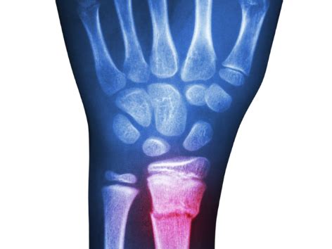 Radius Fracture 的图像结果