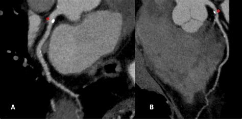 Computertomografie vs. Koronarangiografie: morphologische Diagnostik ...