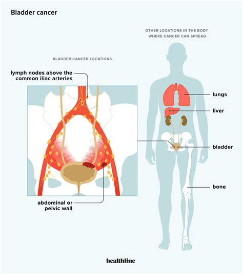 How Does Cancer Spread