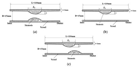 Hemodynamics and Wall Shear Stress of Blood Vessels in Aortic ...