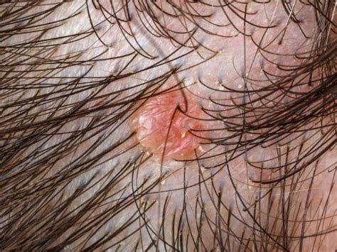 头皮上长小红疙瘩，出现3种症状，警惕是毛囊炎，及时调理