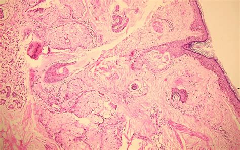 Barraquer‐Simons syndrome in systemic lupus erythematosus: A case ...