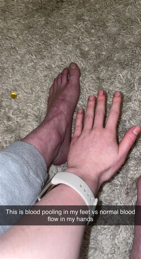is this what blood pooling looks like? (19f newly diagnosed) my feet also are cold ALL THE TIME ...