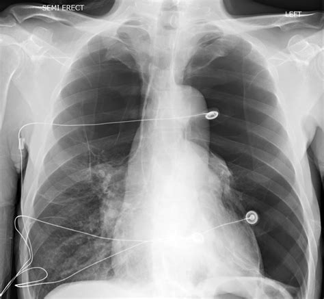 Chest X Ray Bullous Emphysema at Brock Hyland blog