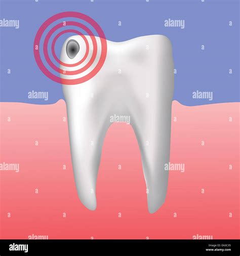 Image result for Tooth Hole