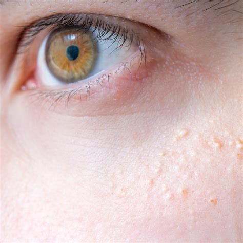 Milia Under Eye Removal Milia Under Eyes: Causes, At Home And Medical