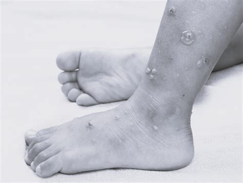 Phlegmasia Alba and Cerulea Dolens | The Chelsea Clinic