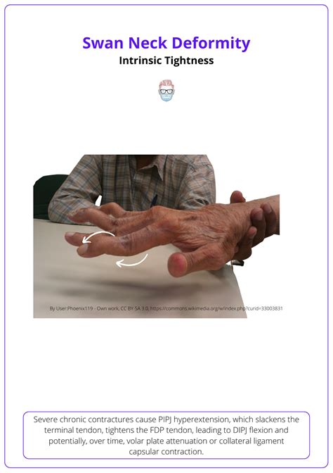 Intrinsic "Plus" Hand: Anatomy, Aetiology, and Management
