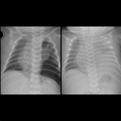 Diaphragmatic Hernia 🫁 Congenital Diaphragmatic Hernia (CDH)