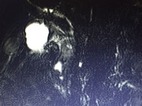 Acute Cholecystitis | Case Study - Severe acute calculous cholecystitis ...
