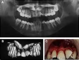 AI-based model may help in early detection of ectopic tooth eruptions ...
