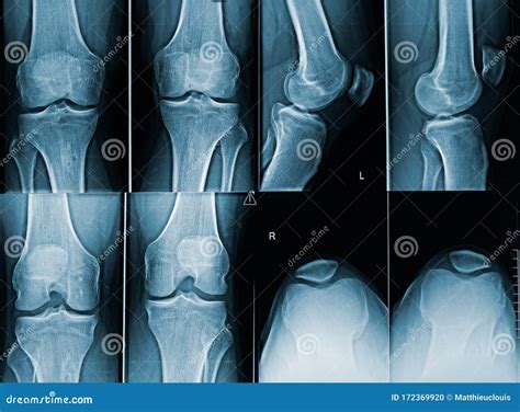 Adult Male Knees X-ray Image. Medical and Human Anatomy Imagery Stock Photo - Image of xray ...