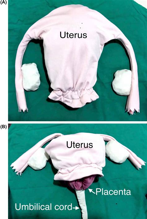 Uterine Inversion - Clinical Tree