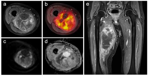Evaluation of the Predictive Potential of 18F-FDG PET and DWI Data Sets ...