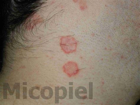 Caso clínico Nº 57. Tiña del Cuerpo – PIEL-L Latinoamericana