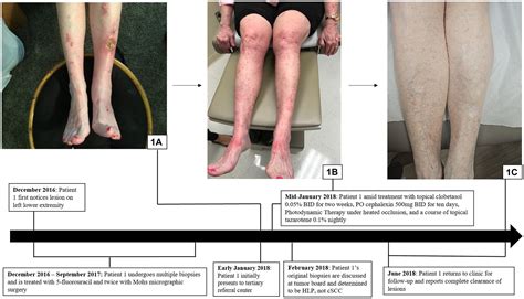 Frontiers | Case report: Hypertrophic lichen planus initially misdiagnosed as squamous cell ...
