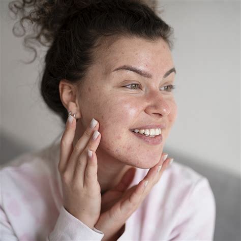 What Causes Acne Scars and How to Help Prevent and Manage Scarring
