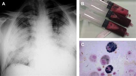 Diffuse alveolar hemorrhage in immunocompetent patients: Etiologies and ...