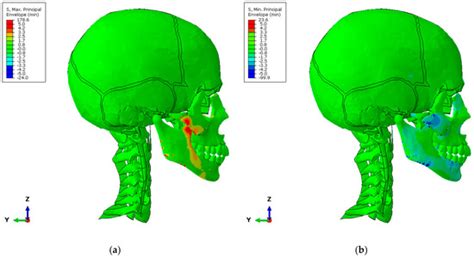 Biomechanical Optimization of the Human Bite Using Numerical Analysis ...