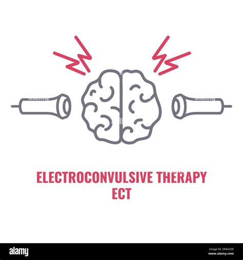Electroconvulsive Therapy Diagram