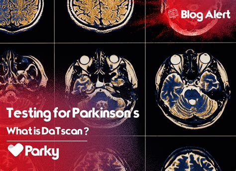 What is Early Onset Parkinson's Disease? - Parky for Parkinson's
