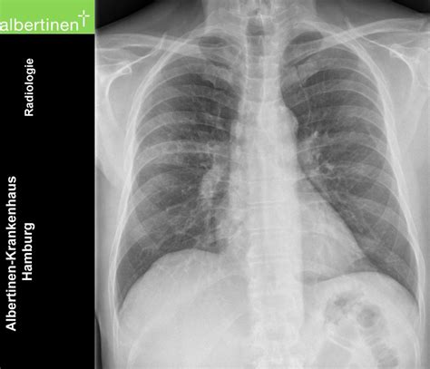 Atypical Pneumonia