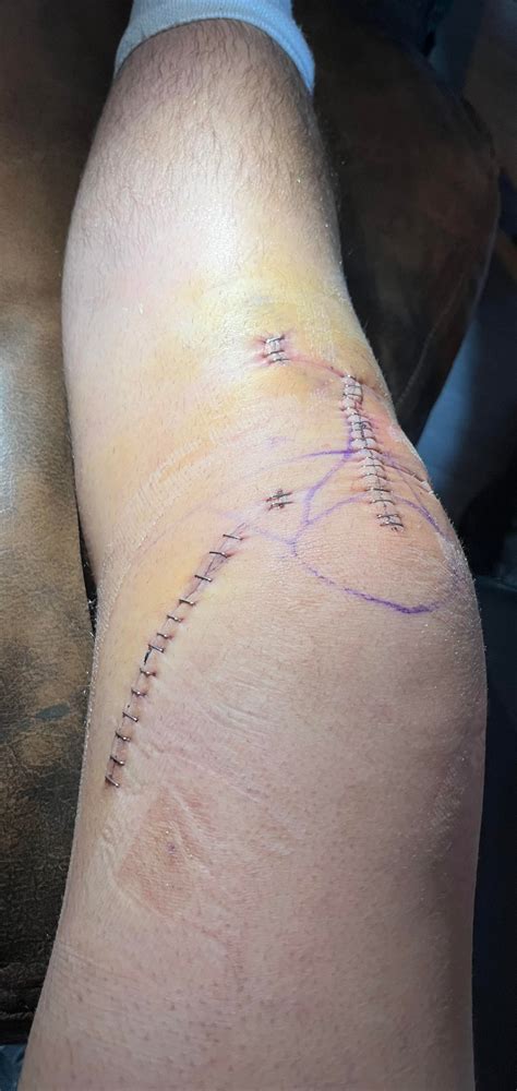 6 days post ACL + MCL reconstruction + two meniscus repairs and lemaire ...