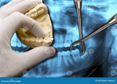 Dentist Show Molar Tooth Extraction Stock Image - Image of hospital, implant: 69574069