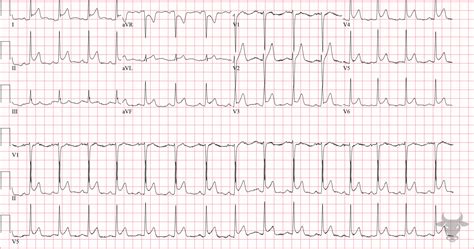 Acute Pericarditis | ECG Stampede