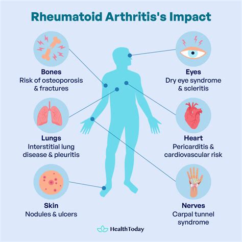 Symptoms Of Rheumatoid Arthritis