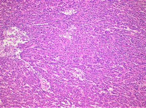 Spindle Cell Tumor Pathology Outlines at Sarah Bugarin blog
