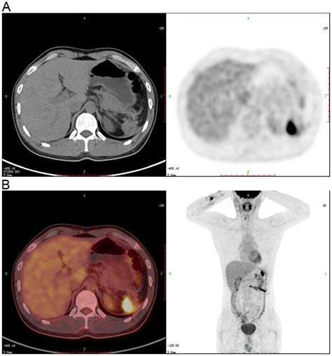 Carcinoma Of Spleen