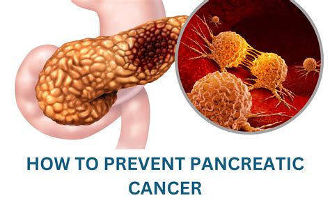 How to prevent Pancreatic Cancer - Apollo Hospitals Blog